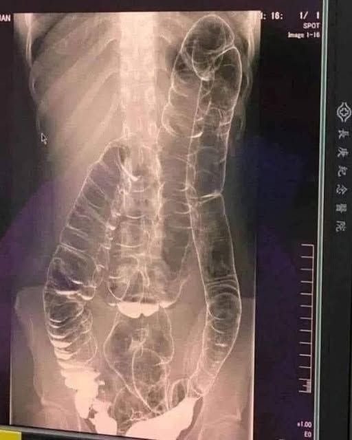 Here’s What You Need To Know About Chronic Constipation: A Silent Killer To Your Digestive Health